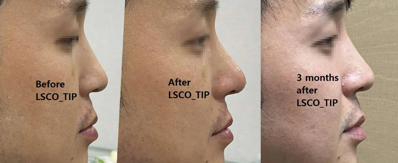صور مقارنة للمظهر الجانبي قبل، وبعد مباشرة، وبعد 3 أشهر من العلاج تجميل طرف الأنف بتقنية LSCO