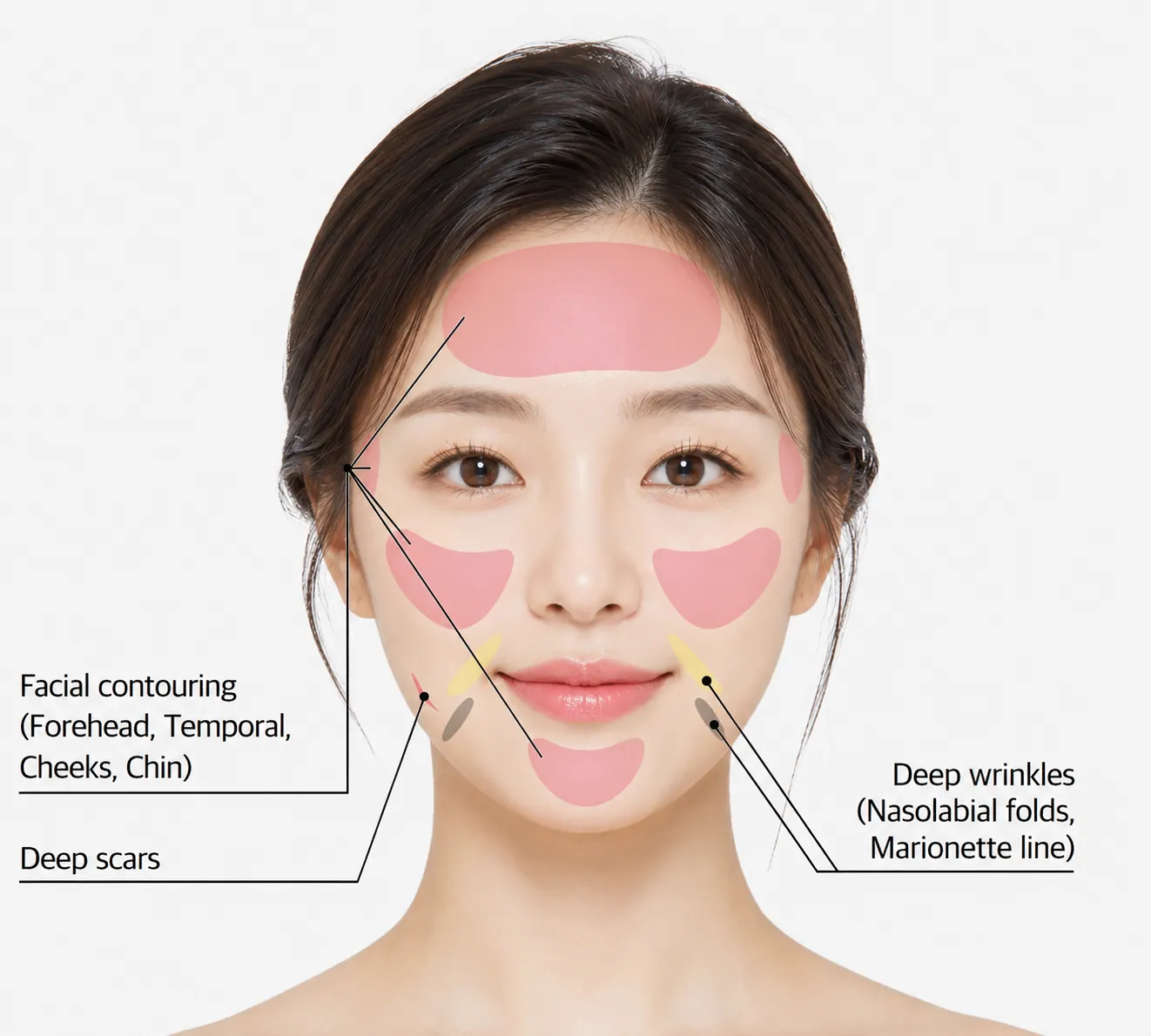 منطقة العلاج حجم Juvelook